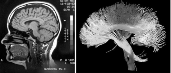 egas moniz pionero de la neurologa y la vida del premio nobel